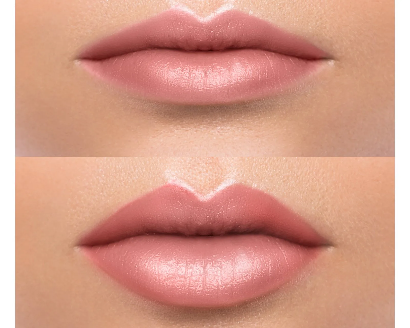 Lip filler before and after at Forever Glow Aesthetics & Wellness in Leander, TX — naturally fuller, balanced, hydrated lips with no overdone volume