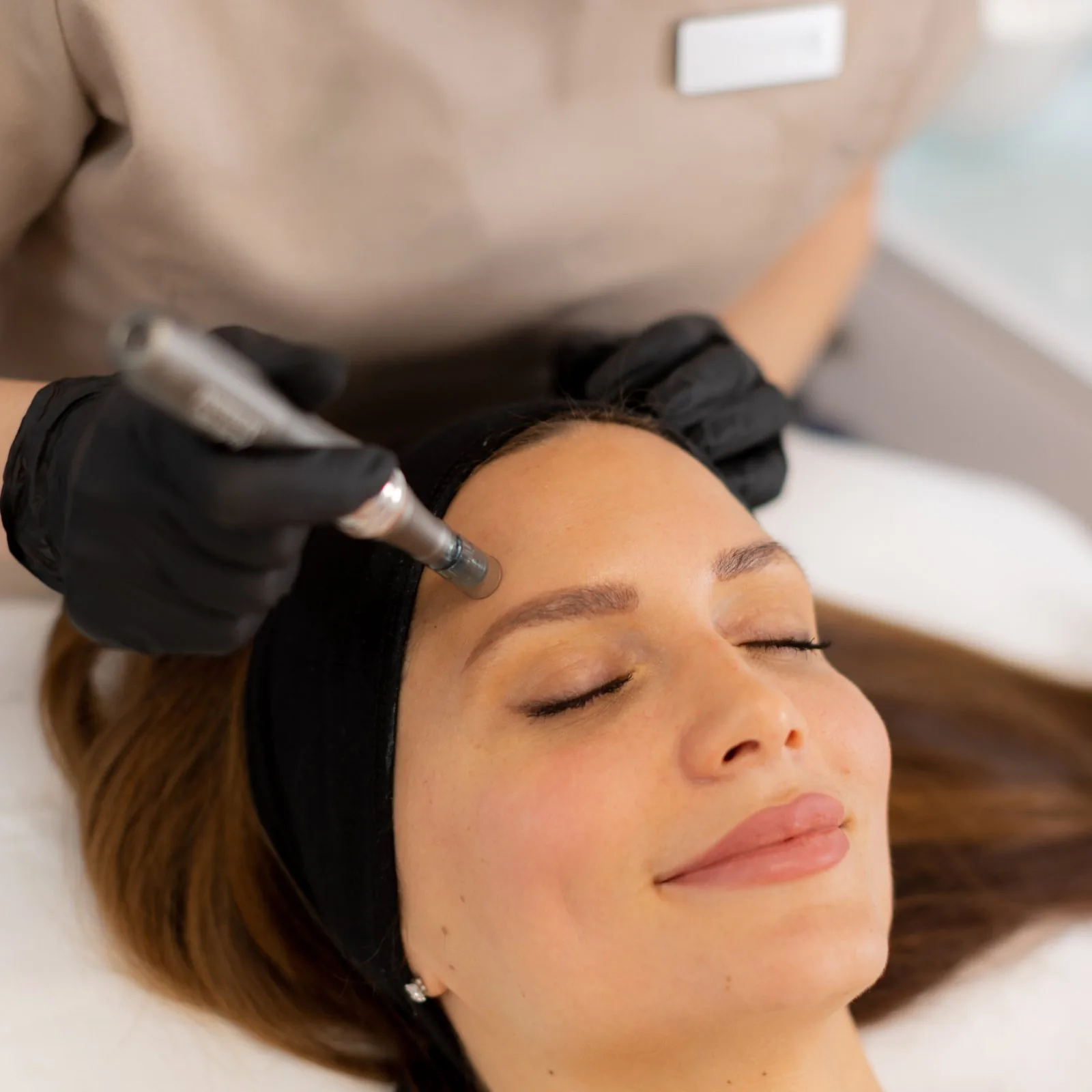 Microneedling with Stem Cells: Who Is It Best For?