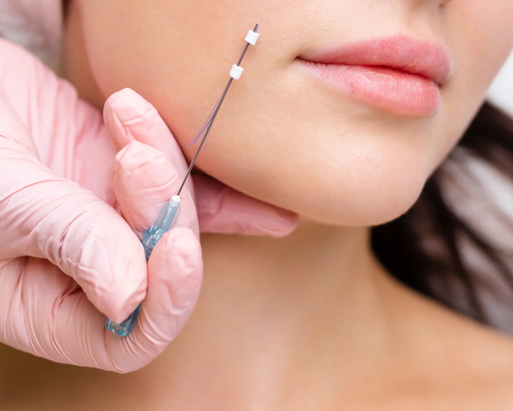 PDO Thread Lift: What It Can and Cannot Do
